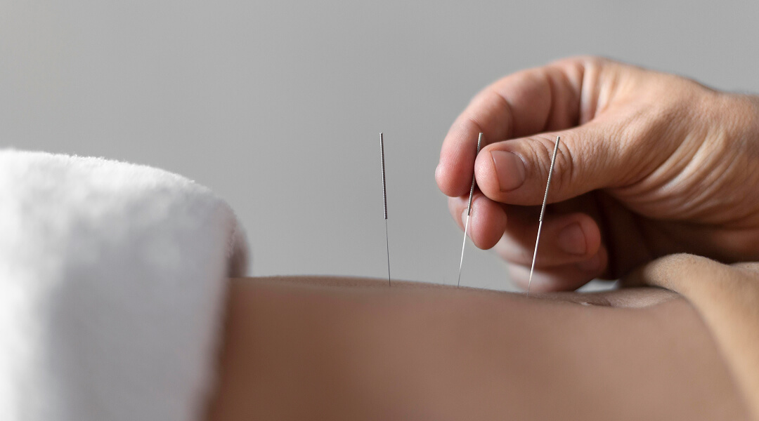 Acupuncture pour soulager la douleur au dos, avec des aiguilles insérées dans des points spécifiques du corps.
